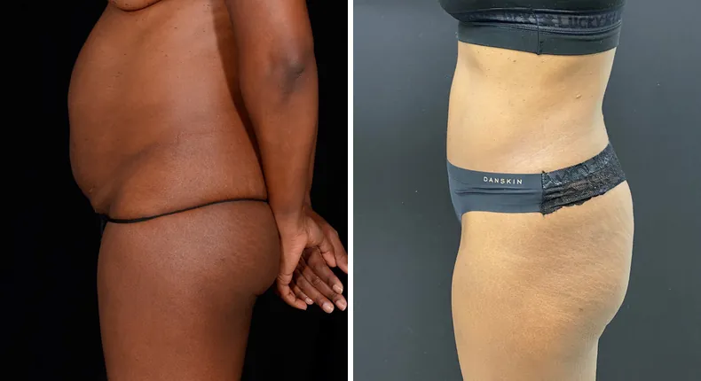 Before and after tummy tuck: patient's abdomen from the left side