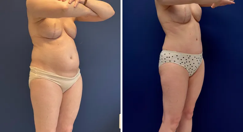 Before and after tummy tuck: patient's abdomen