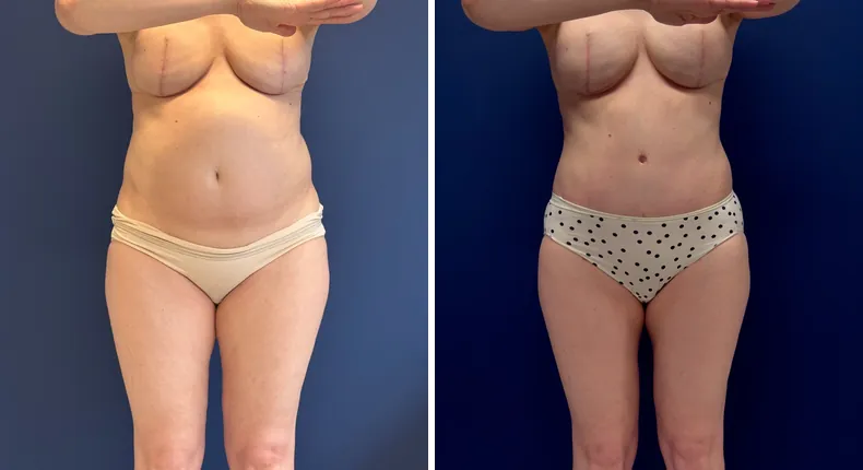 Before and after tummy tuck: patient's abdomen