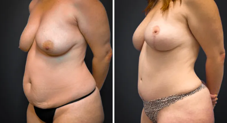 Before and after tummy tuck: patient's abdomen at a left angle