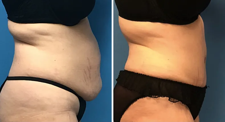Before and after tummy tuck: woman's abdomen from the right side, with liposuction