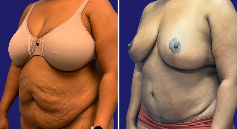 Before and after tummy tuck: woman's abdomen, with breast reduction and liposuction