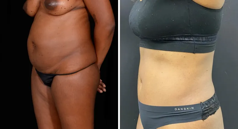 Before and after tummy tuck: patient's abdomen at a left angle, with liposuction