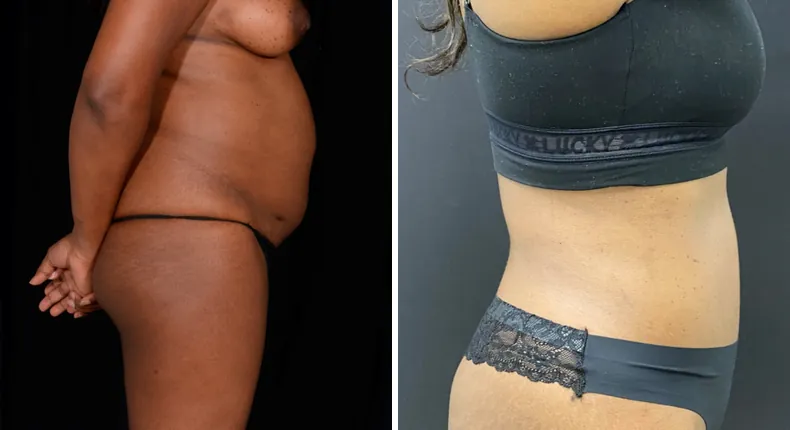 Before and after tummy tuck: patient's abdomen in right profile, with liposuction