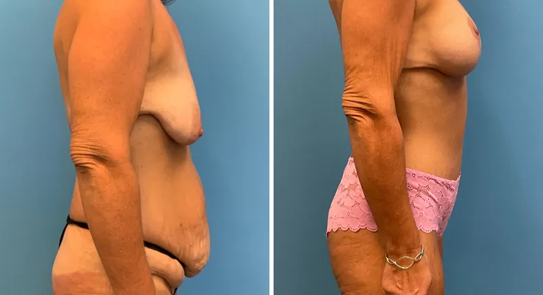 Before and after tummy tuck: patient's abdomen from the right side