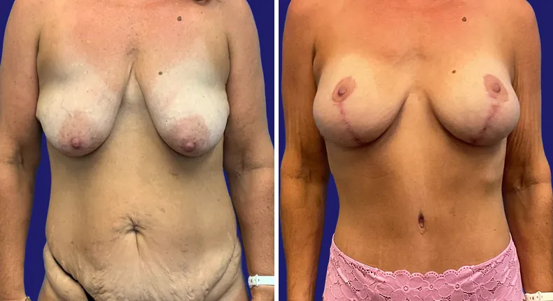 Before and after tummy tuck: woman's abdomen, with breast augmentation, breast lift, liposuction, mommy makeover and arm lift