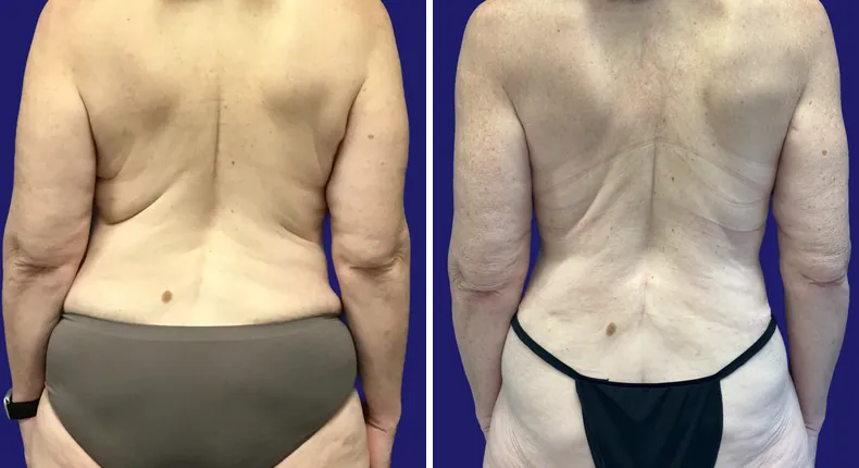 Before and after tummy tuck: woman's abdomen, with liposuction and mommy makeover
