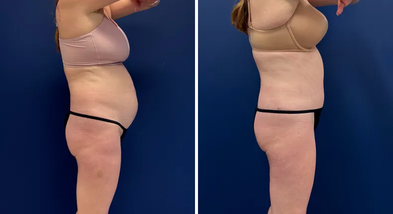 Before and after tummy tuck: patient's abdomen