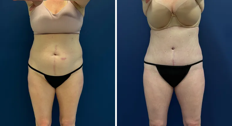 Before and after tummy tuck: patient's abdomen