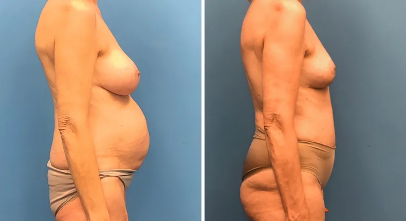 Before and after tummy tuck: patient's abdomen from the right side, with breast lift and liposuction