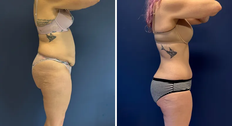 Before and after tummy tuck: patient's abdomen