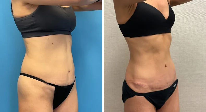 Before and after tummy tuck: patient's abdomen at a right angle
