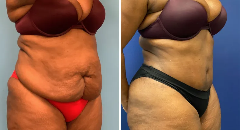 Before and after tummy tuck: patient's abdomen at a right angle