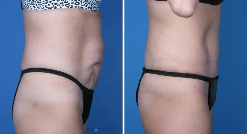 Before and after tummy tuck: woman's abdomen from the right side