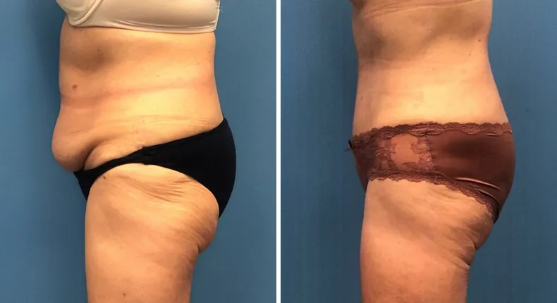 Before and after tummy tuck: patient's abdomen from the left side, with liposuction