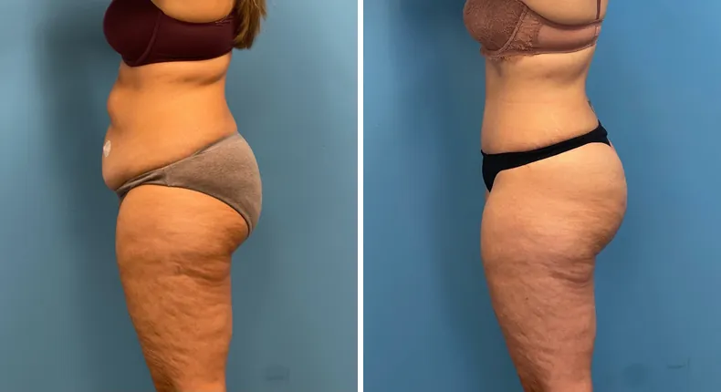 Before and after tummy tuck: patient's abdomen in left profile, with liposuction