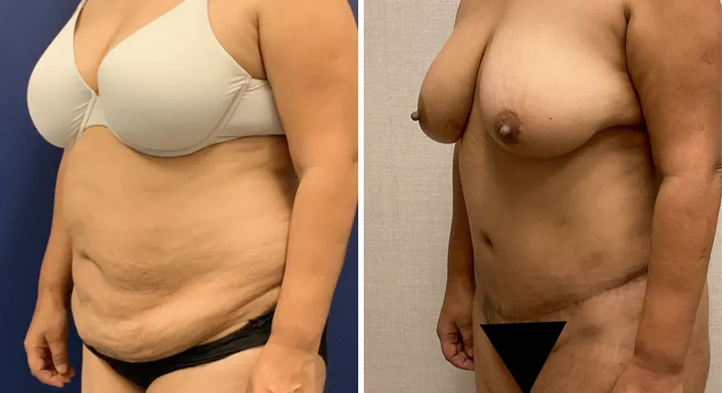 Before and after tummy tuck: patient's abdomen at a left angle, with liposuction
