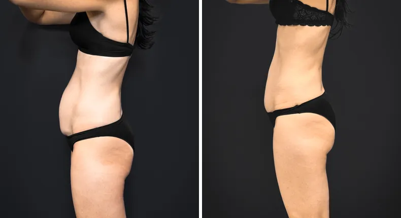 Before and after tummy tuck: patient's abdomen from the left side