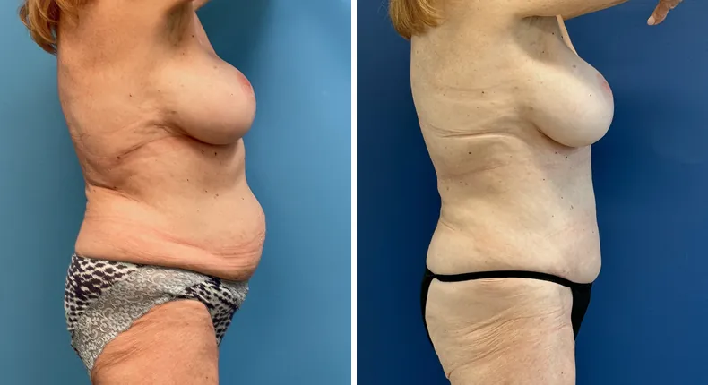 Before and after tummy tuck: patient's abdomen from the right side, with liposuction