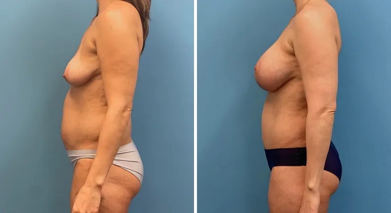 Before and after tummy tuck: patient's abdomen from the left side, with body lift, breast augmentation with lift and liposuction