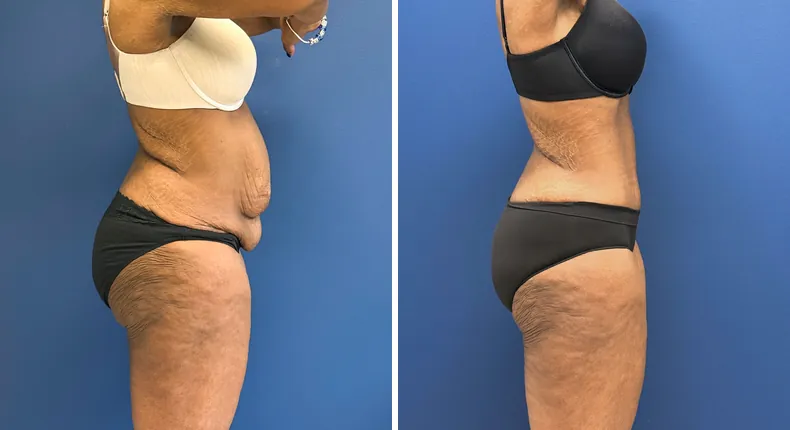 Before and after tummy tuck: patient's abdomen from the right side