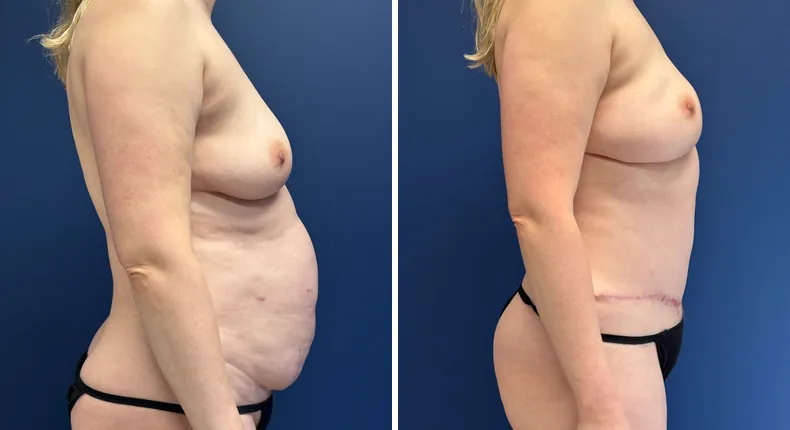 Before and after tummy tuck: woman's abdomen from the right side, with liposuction and breast reconstruction