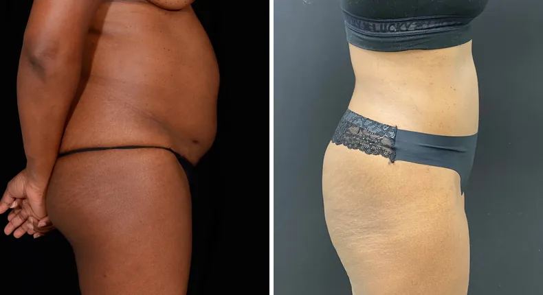 Before and after tummy tuck: patient's abdomen from the right side