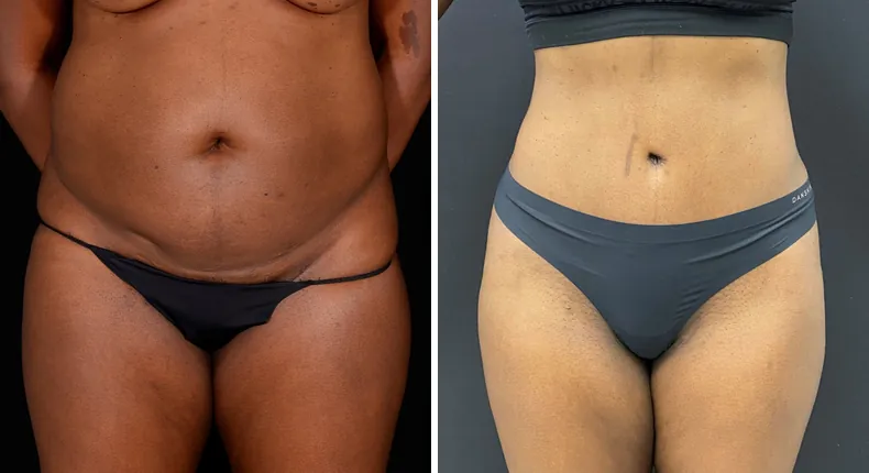Before and after tummy tuck: patient's abdomen from the front