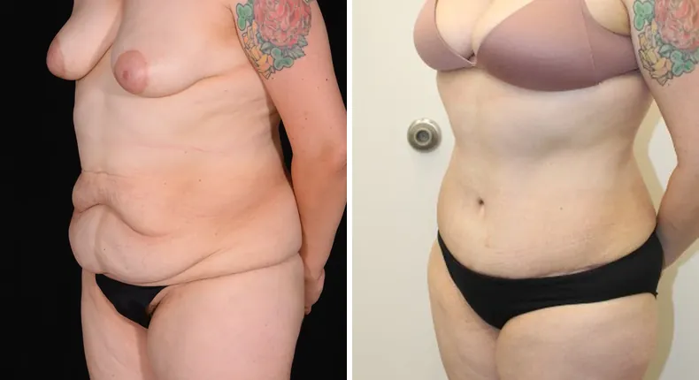 Before and after tummy tuck: patient's abdomen at a left angle, with liposuction