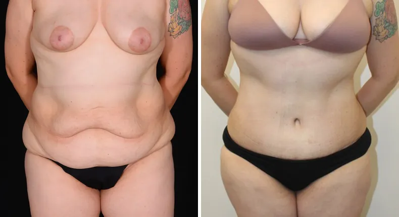 Before and after tummy tuck: patient's abdomen from the front, with liposuction