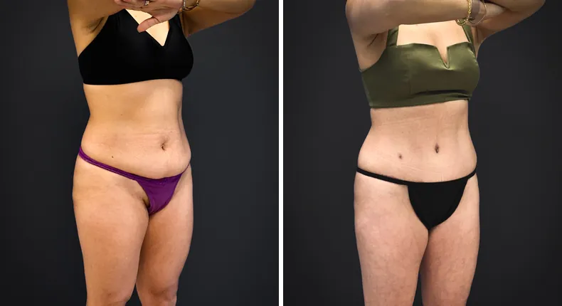 Before and after tummy tuck: patient's abdomen from the right side