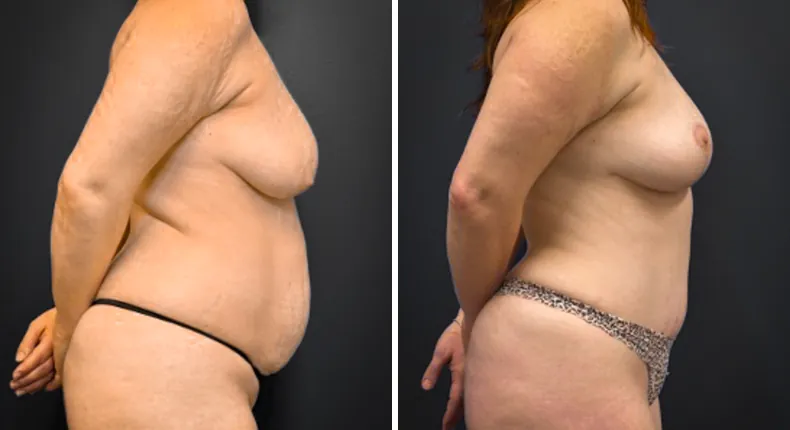 Before and after tummy tuck: patient's abdomen from the right side