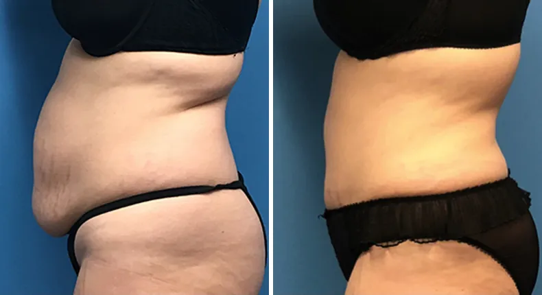 Before and after tummy tuck: woman's abdomen from the left side, with liposuction