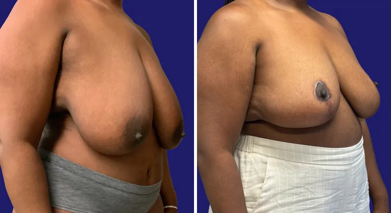 Before and after tummy tuck: woman's abdomen, with breast reduction and liposuction