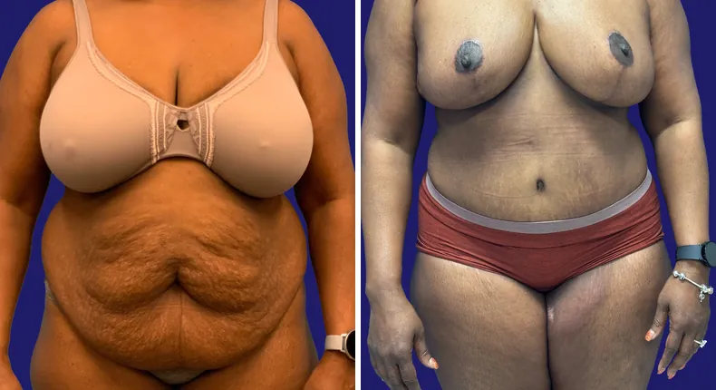 Before and after tummy tuck: woman's abdomen, with breast reduction and liposuction