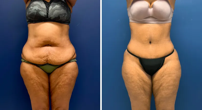 Before and after tummy tuck: patient's abdomen, with liposuction