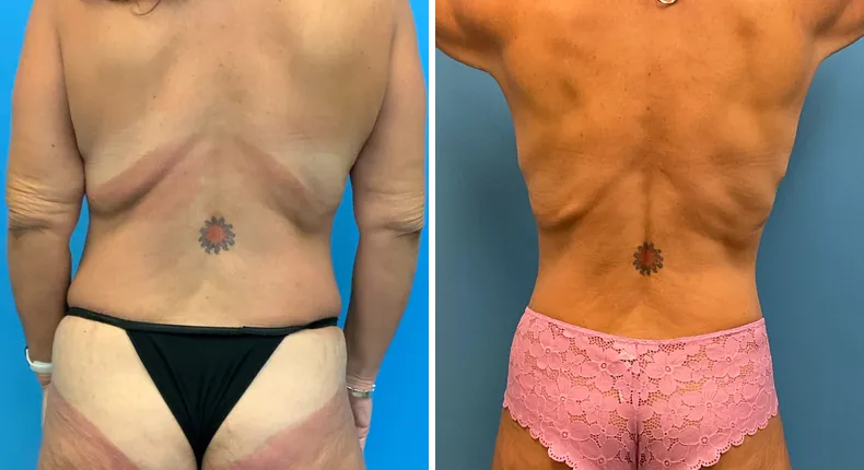 Before and after tummy tuck: patient's abdomen