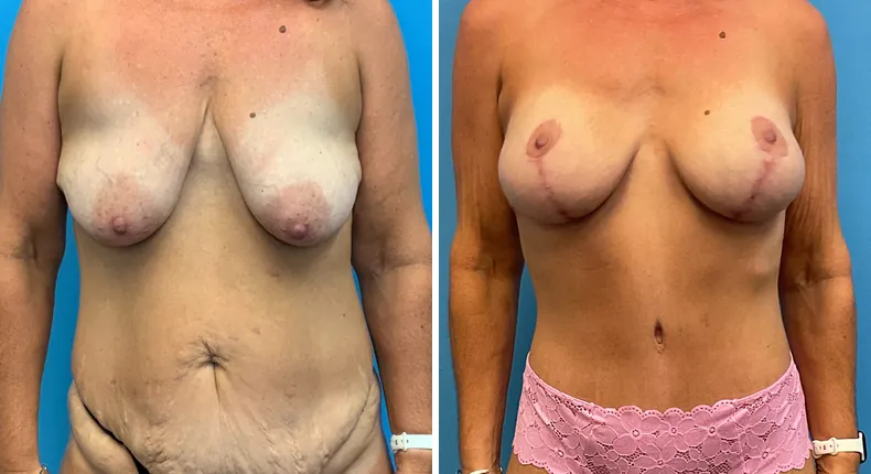 Before and after tummy tuck: patient's abdomen
