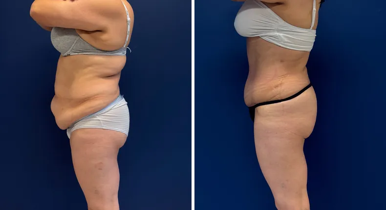 Before and after tummy tuck: patient's abdomen