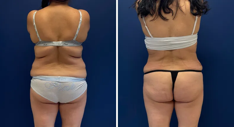 Before and after tummy tuck: patient's abdomen