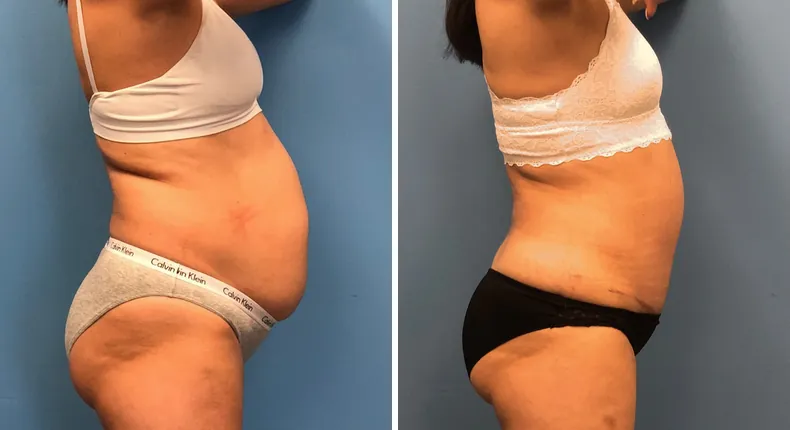 Before and after tummy tuck: woman's abdomen from the right side, with liposuction