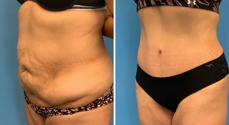 Before and after tummy tuck: patient's abdomen at a left angle