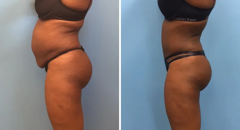 Before and after tummy tuck: woman's abdomen from the left side, with liposuction