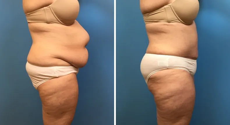 Before and after tummy tuck: woman's abdomen from the right side, with liposuction