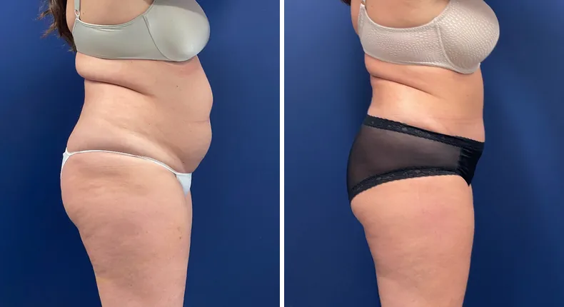 Before and after tummy tuck: patient's abdomen in right profile