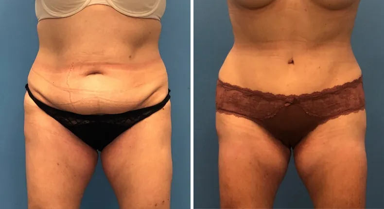 Before and after tummy tuck: patient's abdomen from the front, with liposuction