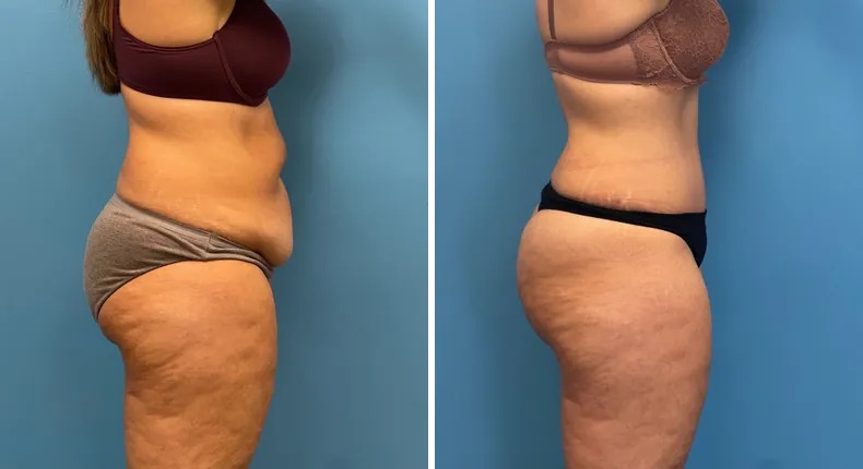 Before and after tummy tuck: patient's abdomen in right profile, with liposuction