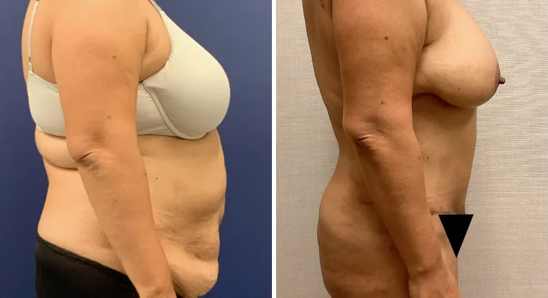 Before and after tummy tuck: patient's abdomen from the right side, with liposuction