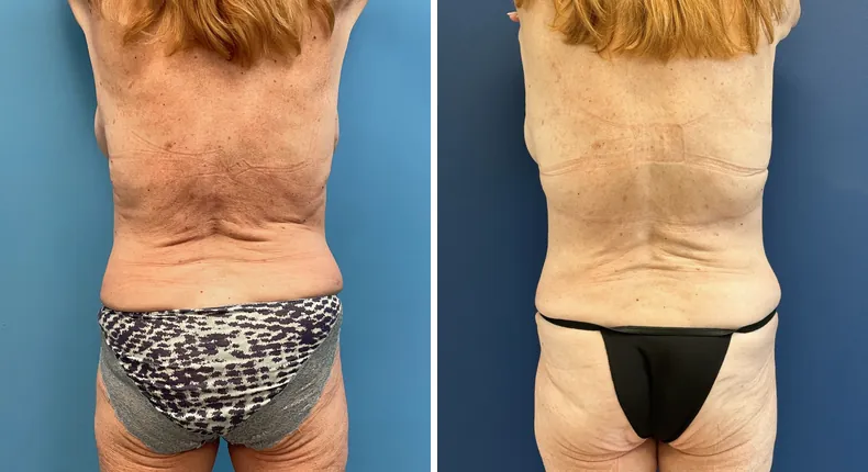 Before and after tummy tuck: patient's abdomen from the back, with liposuction