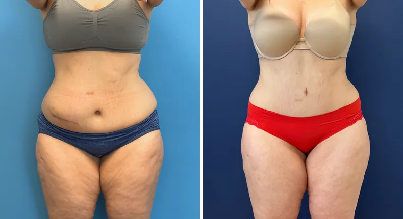 Before and after tummy tuck: patient's abdomen from the front